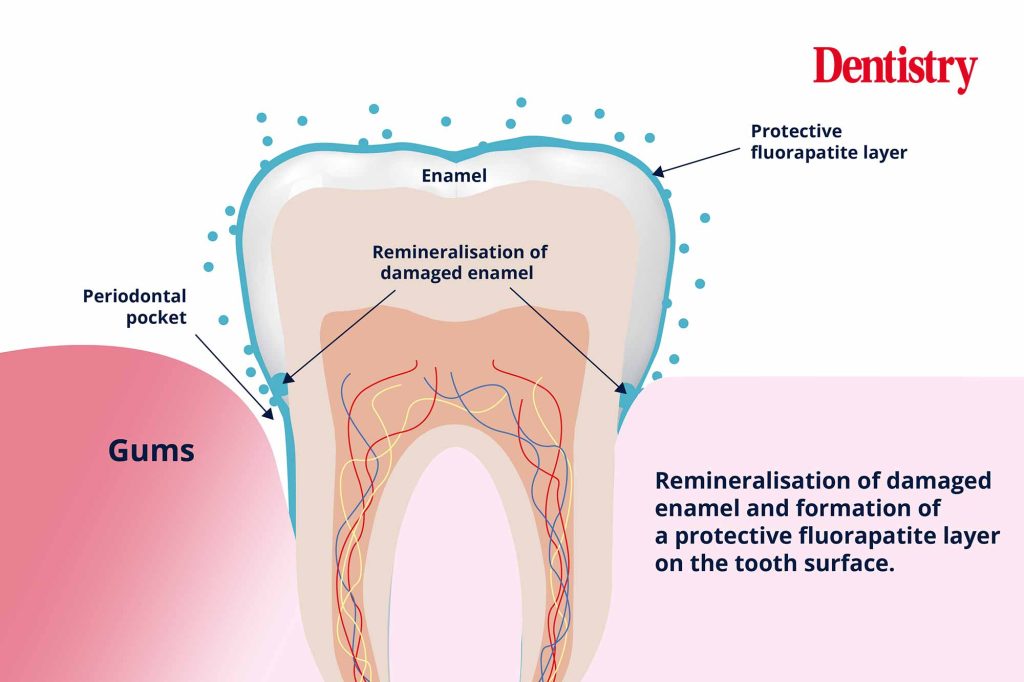 Biomin F armour for teeth Dentistry