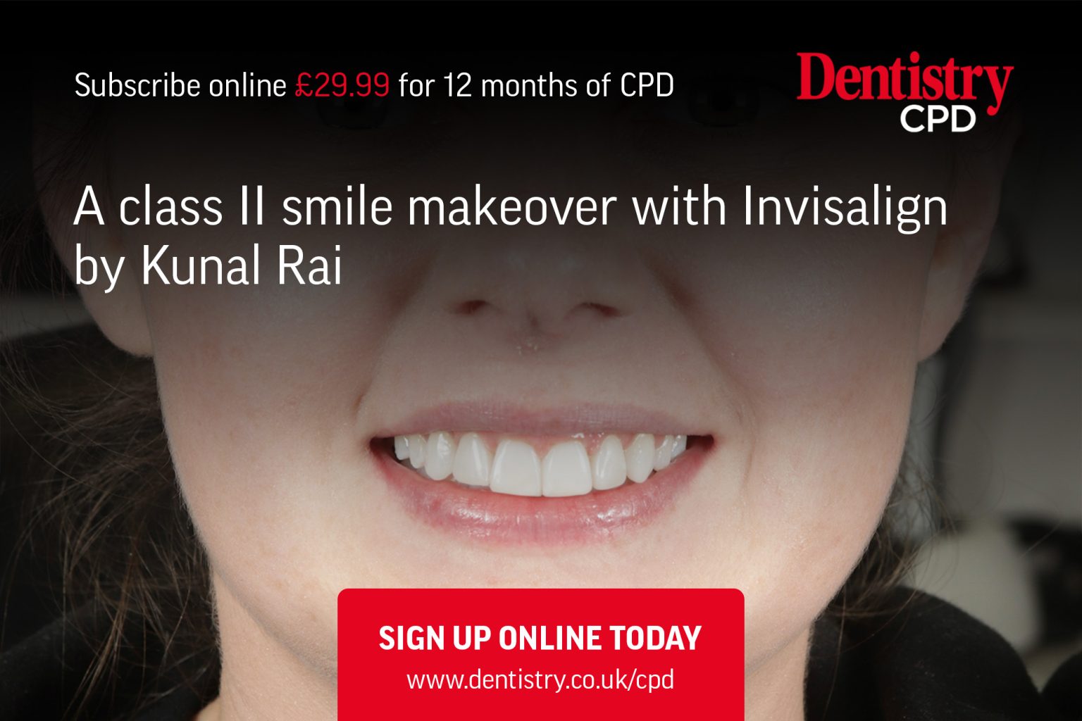 A class II smile makeover with Invisalign Dentistry