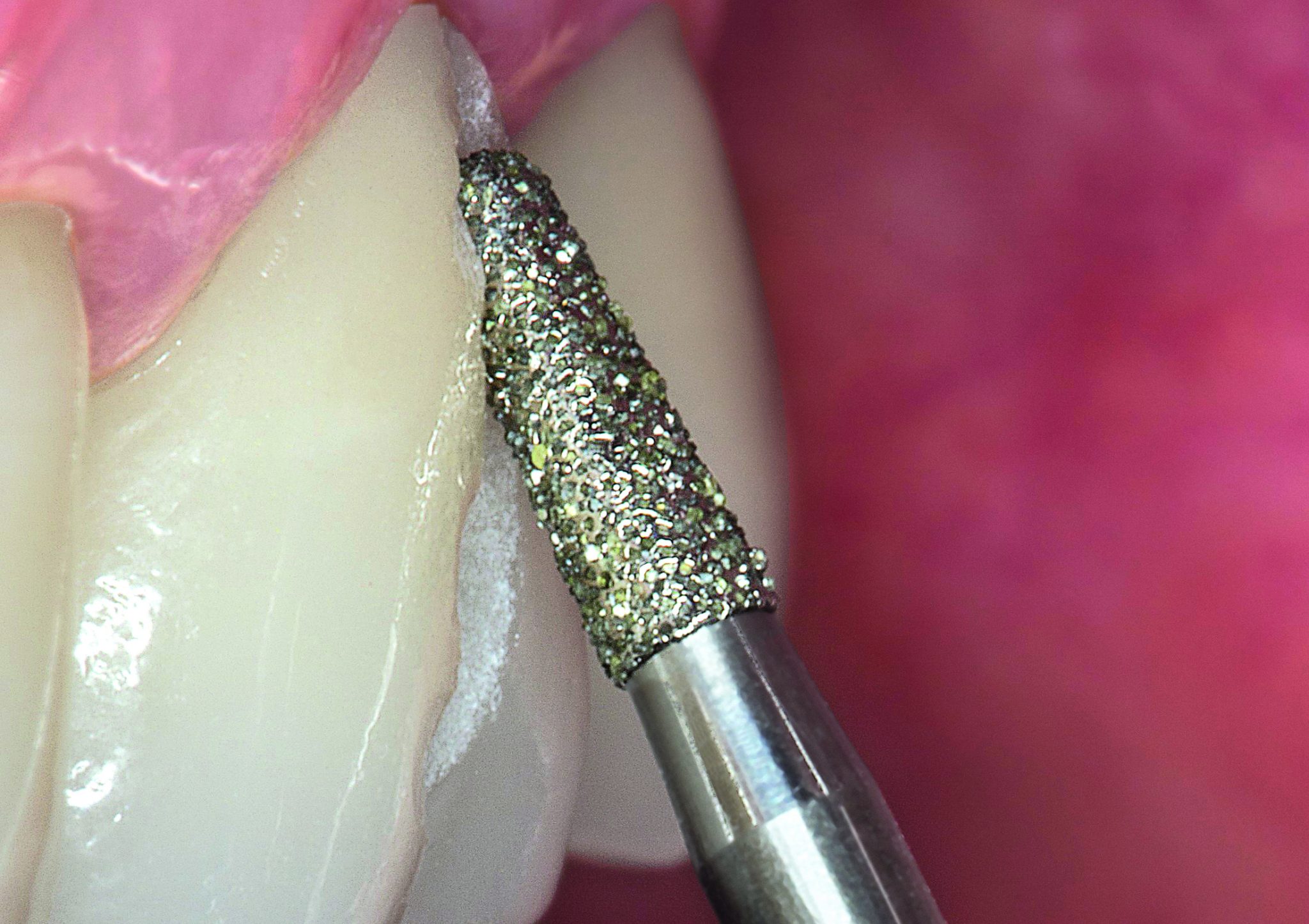 Want to make crown cutting easier? Dentistry.co.uk