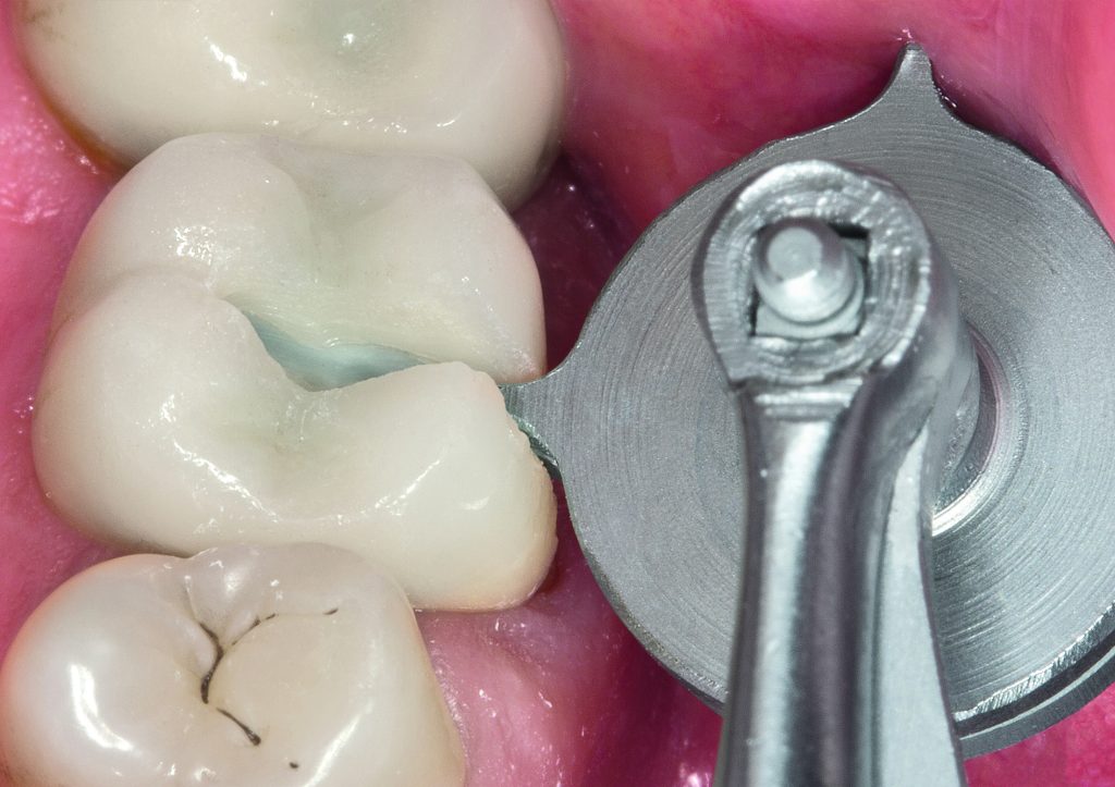 Want to make crown cutting easier? Dentistry.co.uk