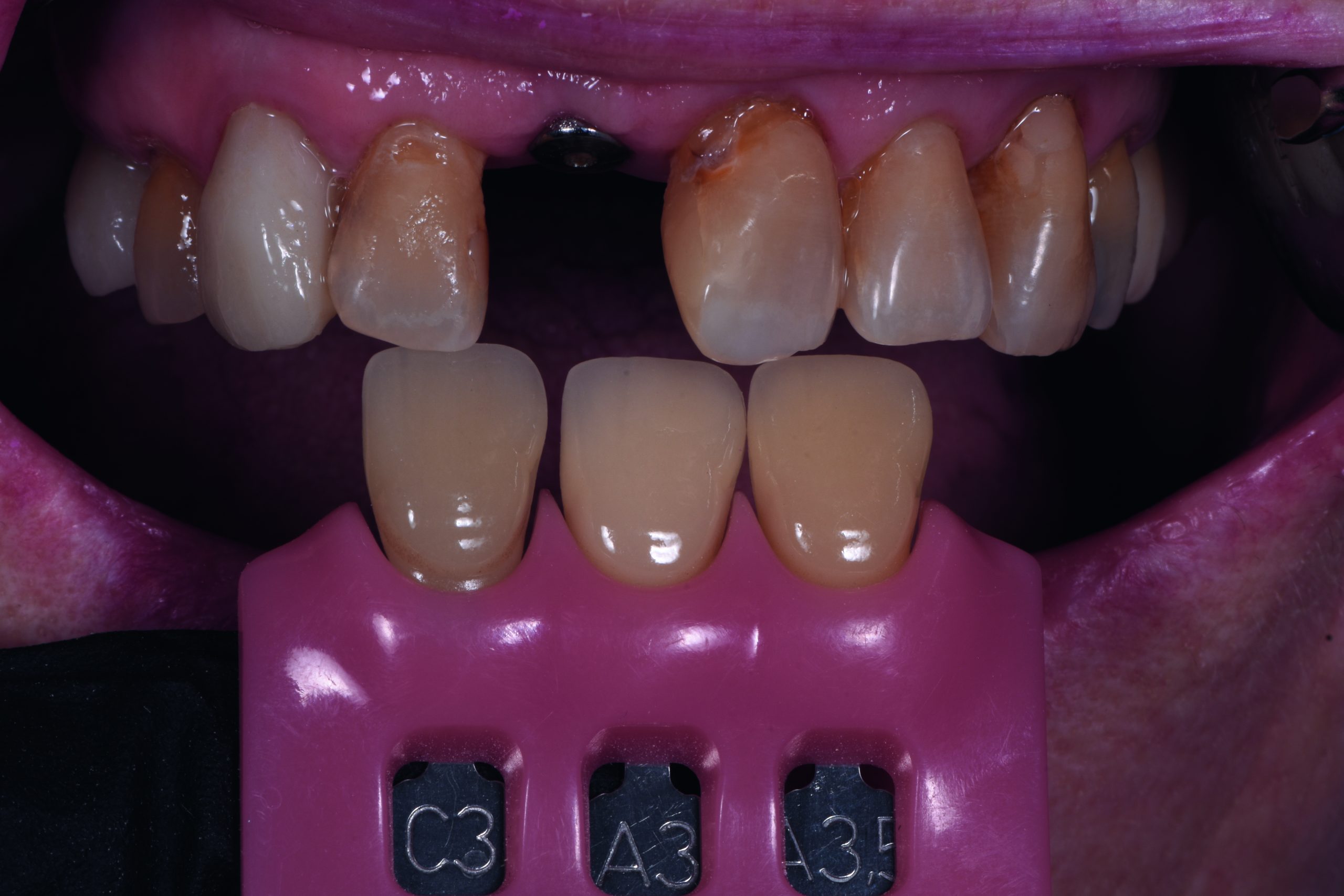 Dimitri Kisel presents a challenging implant restoration case in which a precise shade analysis created a natural-looking, aesthetic result. 