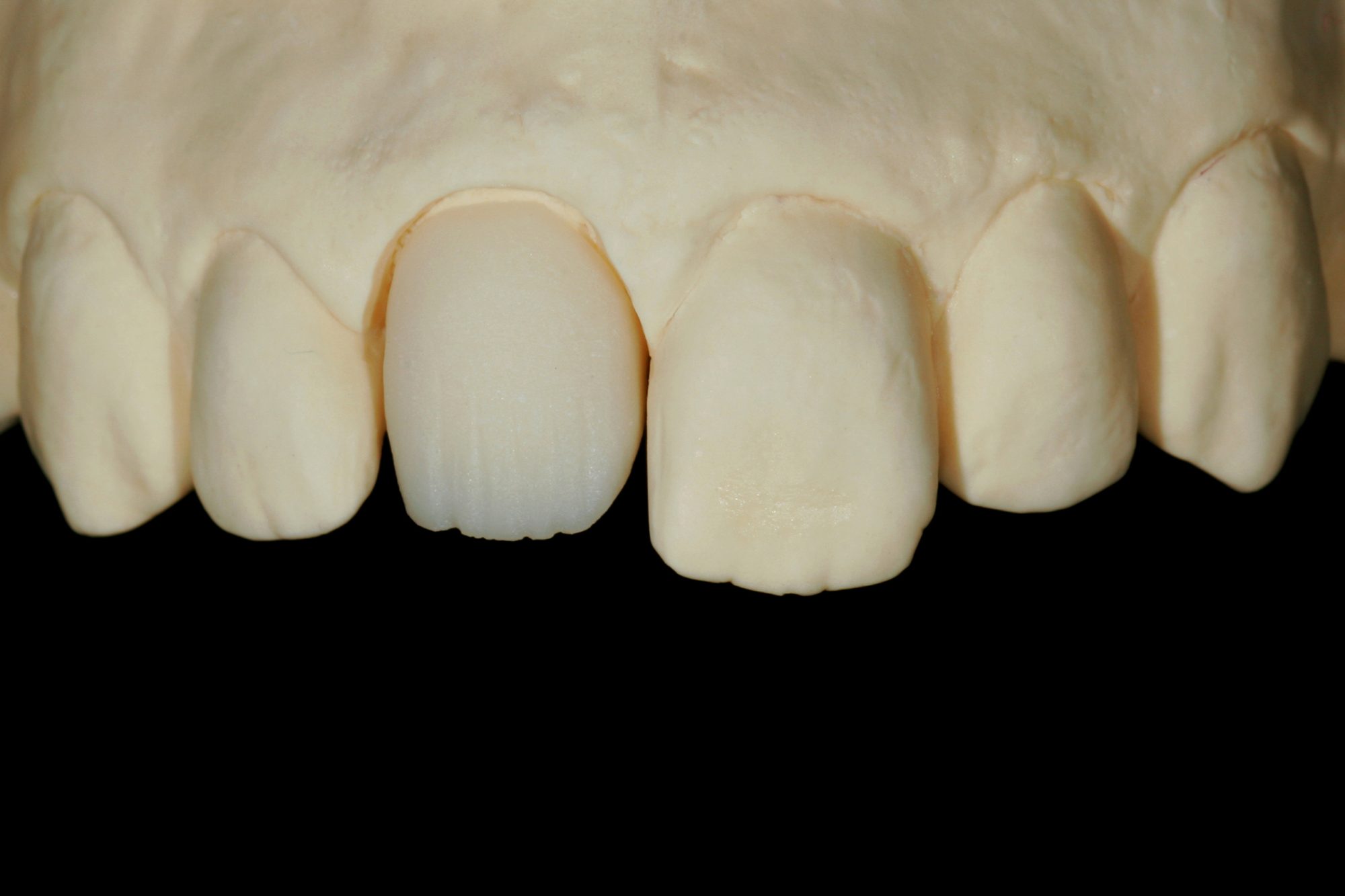 Ceramic crown for a complicated tooth fracture Dentistry