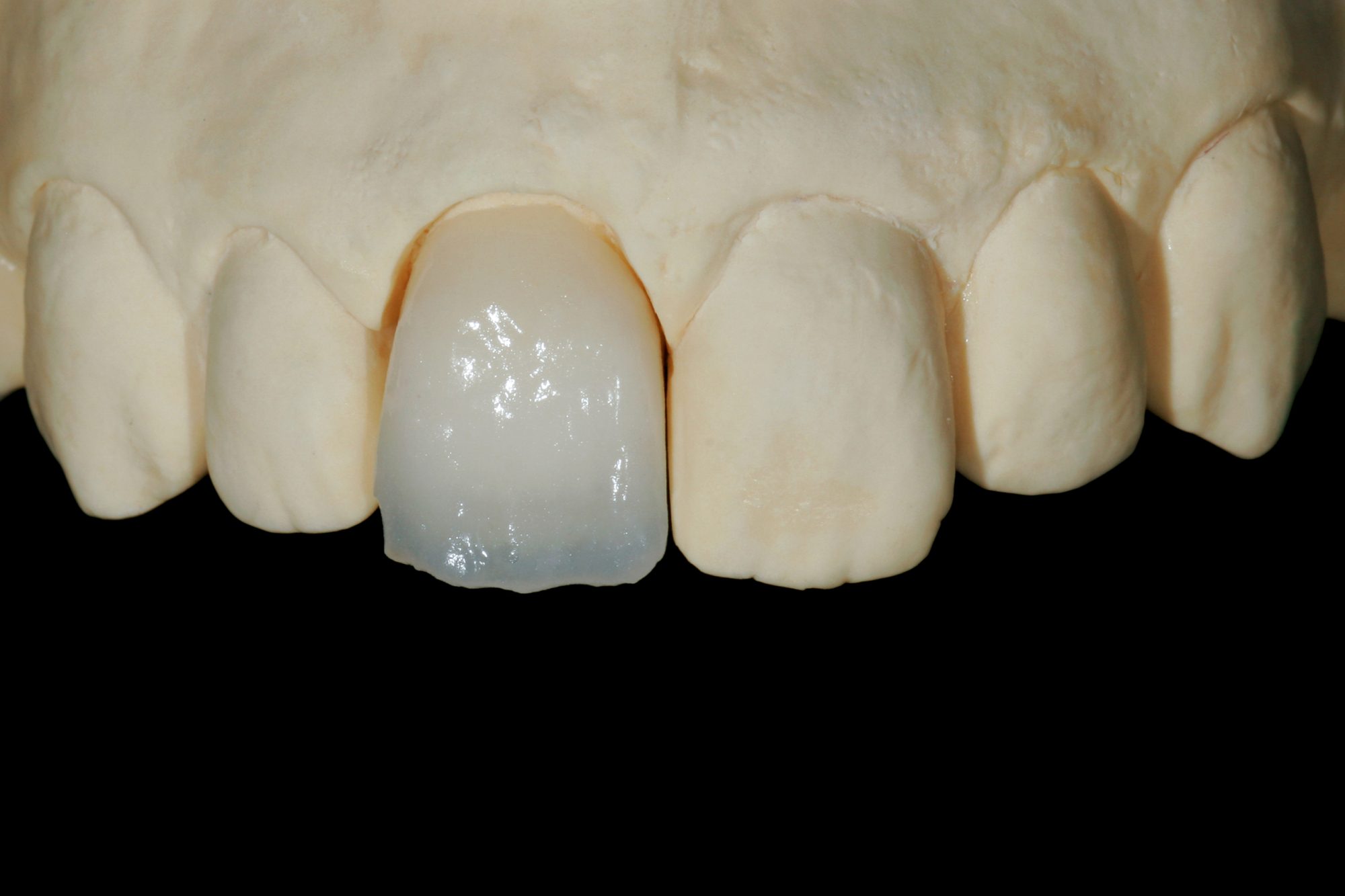 Ceramic crown for a complicated tooth fracture - Dentistry