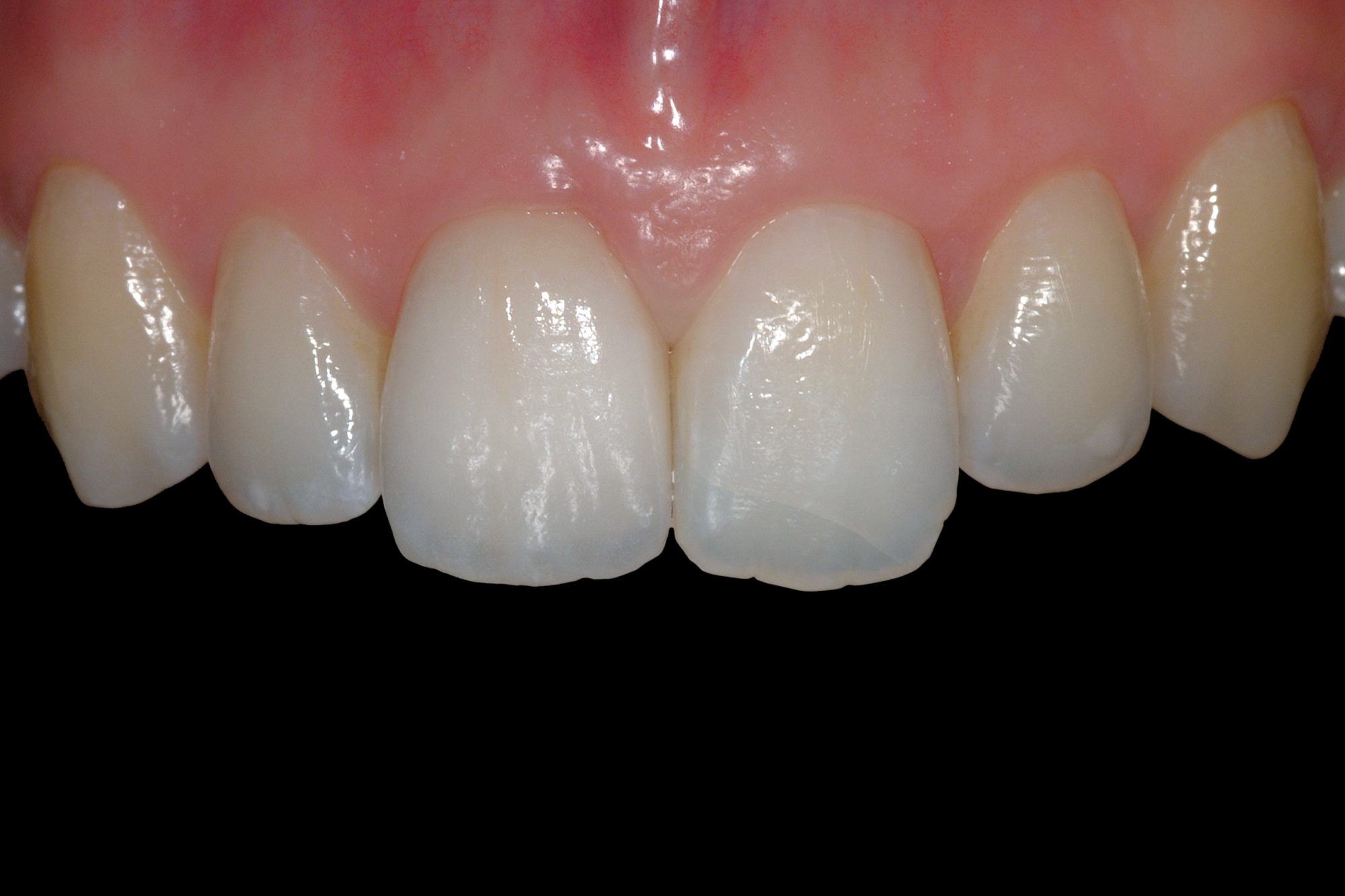 Ceramic crown for a complicated tooth fracture - Dentistry