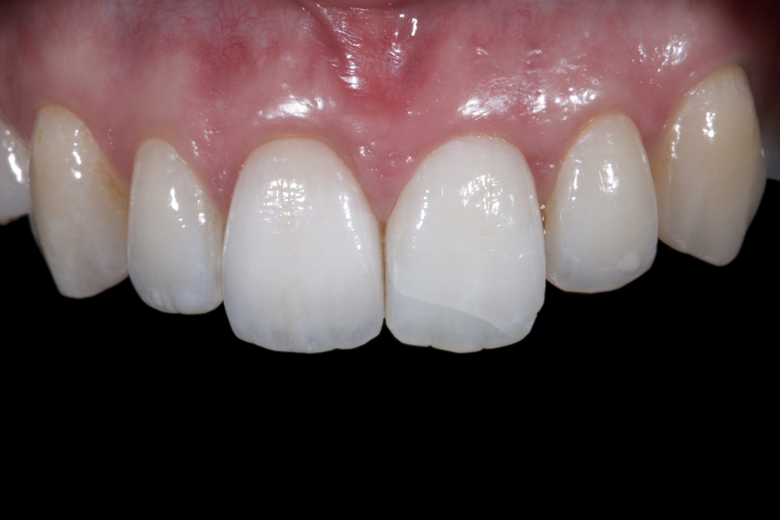 Ceramic Crown_025b Dentistry.co.uk