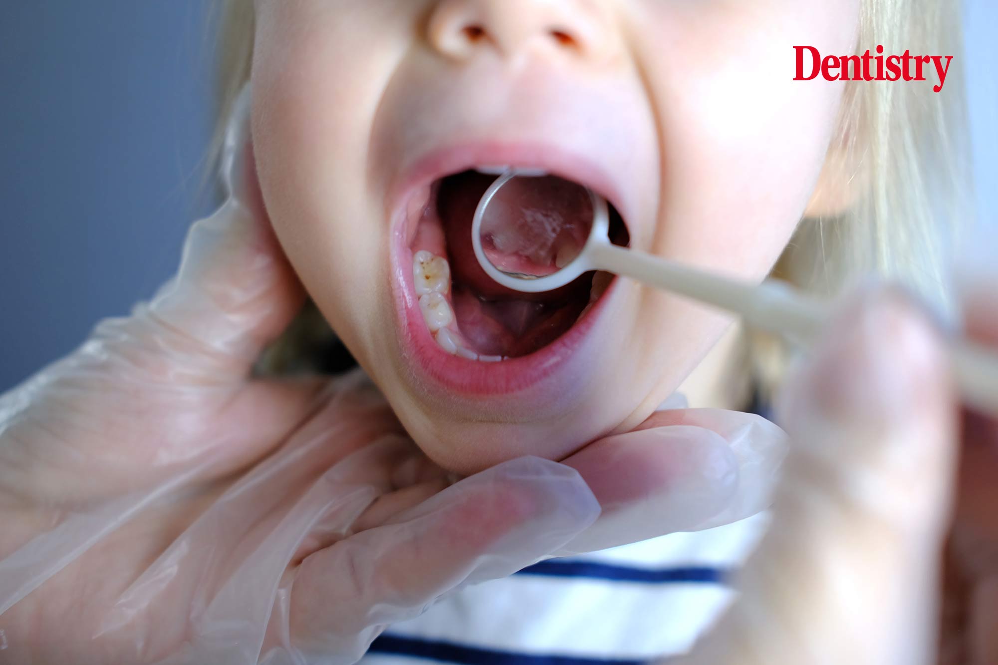 Children’s oral health in England is 'national disgrace', says head of royal college