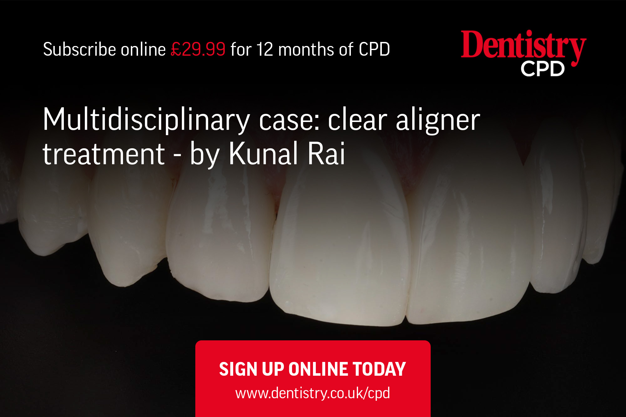 Kunal Rai presents a multidisciplinary case highlighting how careful case selection, assessment and treatment planning can provide an excellent outcome for patients using the Invisalign system.