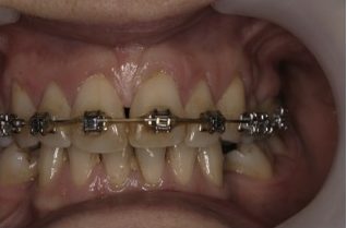 Richard Jones, a specialist orthodontist at Total Orthodontics, part of Bupa Dental Care, discusses ‘Black Triangles’ and how to reduce the risk of them.