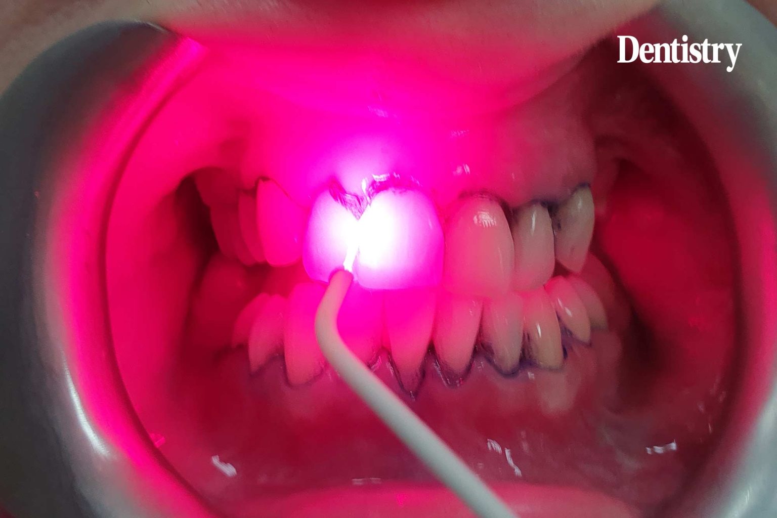 Safe and effective photodynamic therapy  Dentistry.co.uk