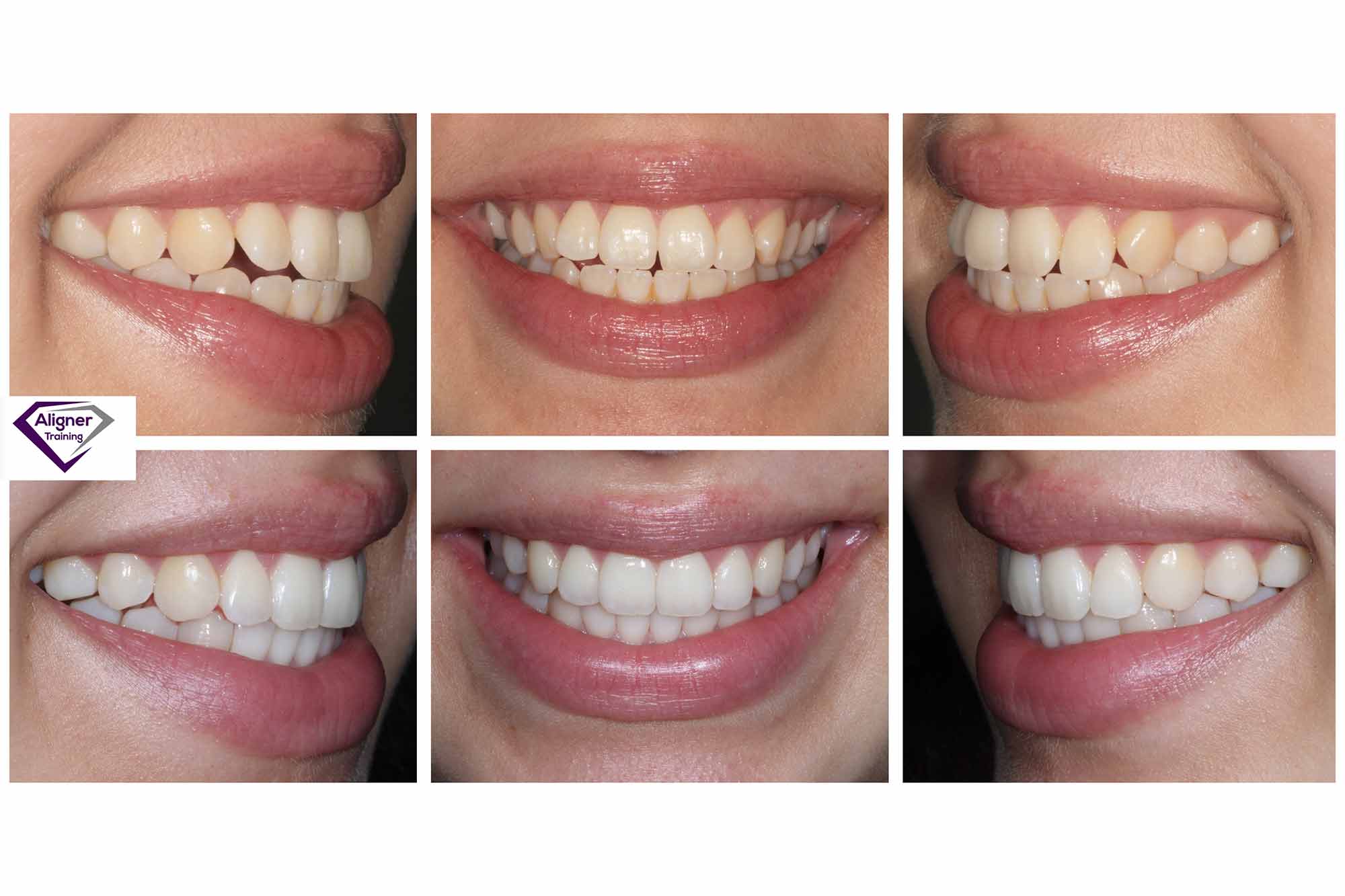 Clear aligner therapy with minimum maintenance
